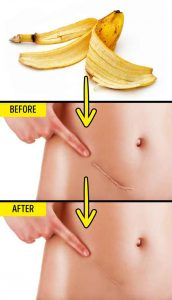 Banana-Peel-Reduce-Scars